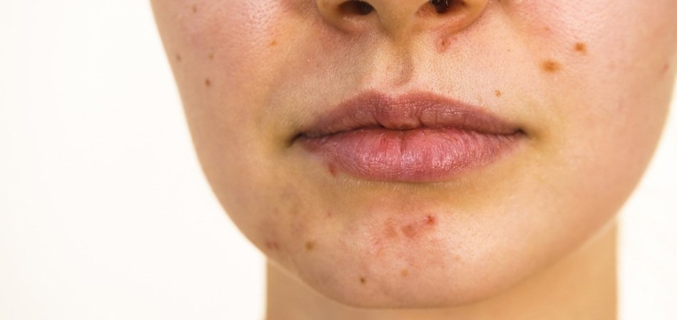 Young woman with spots | how to get rid of spots