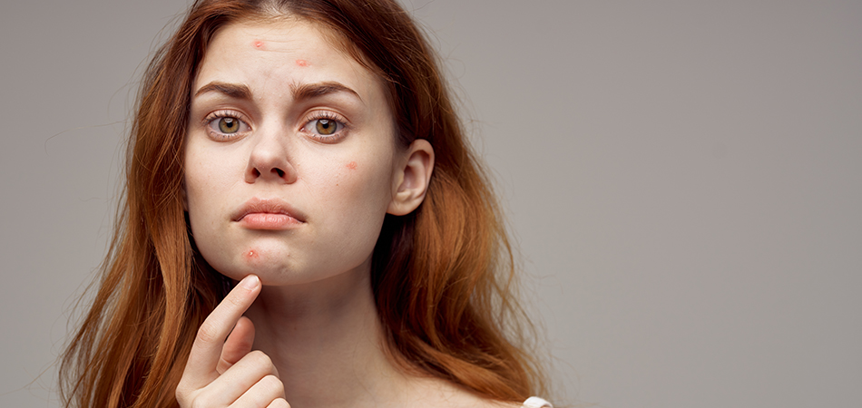 Woman with spots and acne | HRI Teen Skin