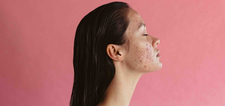 Herbal remedies for acne | HRI Herbal Medicine